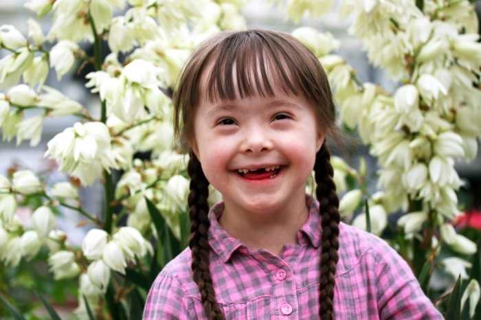 Picture 5 of Learn Down syndrome and the truth you should know