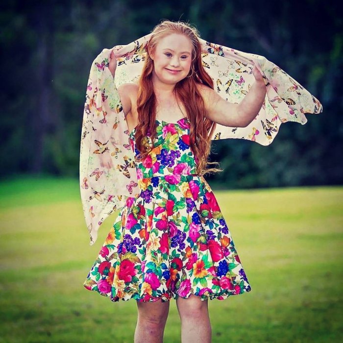 Picture 6 of Learn Down syndrome and the truth you should know