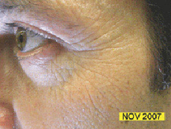 Picture 1 of LEDs can slow the rate of skin aging