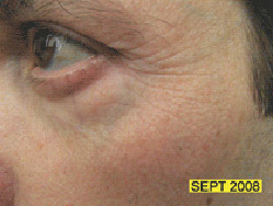Picture 2 of LEDs can slow the rate of skin aging