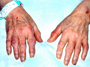 Picture 2 of Leprosy: Drinking coffee, reducing the risk of disease