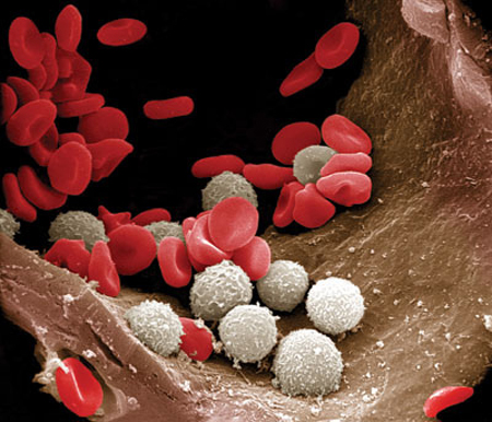 Picture 1 of Leukemia is caused by genes