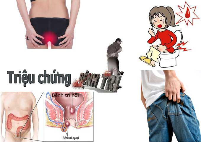 Picture 1 of Levels of hemorrhoids, causes, prevention and diet