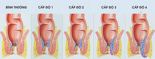Picture 2 of Levels of hemorrhoids, causes, prevention and diet