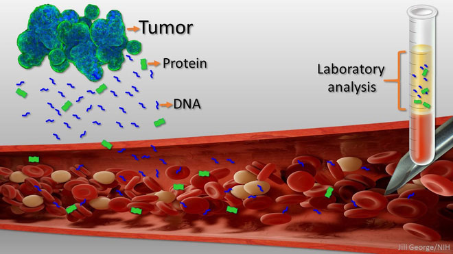Picture 2 of Liquid biopsy: The dream of the world's most prominent oncologist