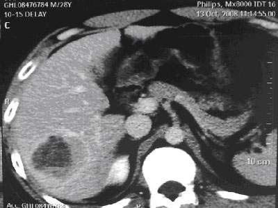 Picture 1 of Liver cancer: can be cured if detected early