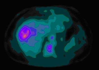 Picture 2 of Liver cancer: can be cured if detected early