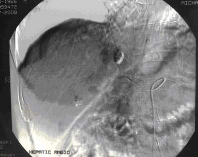 Picture 3 of Liver cancer: can be cured if detected early