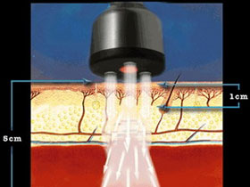 Picture 1 of Low intensity lasers are harmful to people with skin cancer