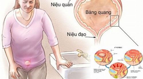 Picture 1 of Lower left abdominal pain signs what disease?