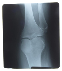 'Lubricating pump' to treat osteoarthritis of the knee images 1