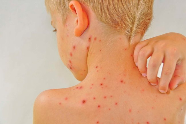 Picture 2 of Lupus erythematosus - A dangerous little known disease