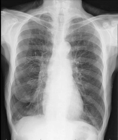 Picture 1 of Major threat of chronic obstructive pulmonary disease