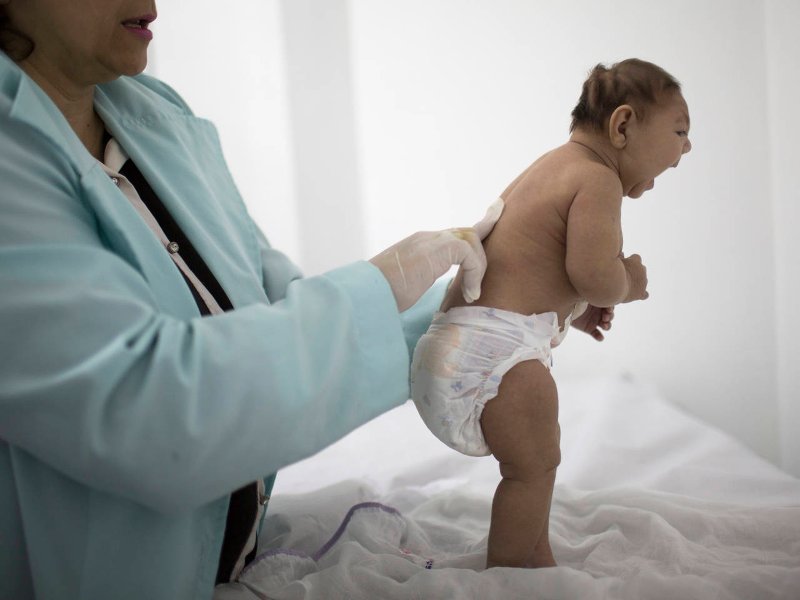 Picture 1 of Make sure Zika virus causes brain atrophy