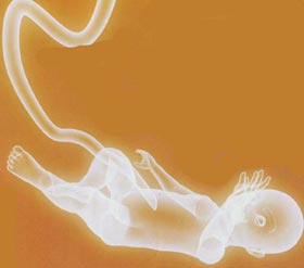 Picture 1 of 'Making stem cell banking from umbilical cord is a trick
