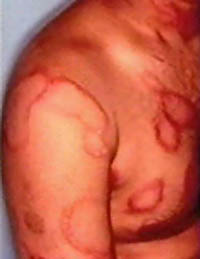 Picture 1 of Management of common skin fungal disease