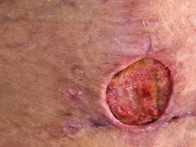 Picture 3 of Manuka honey can control MRSA virus