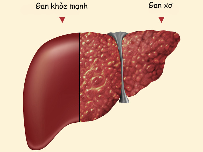 Picture 1 of Many viruses cause hepatitis, most of us do not know