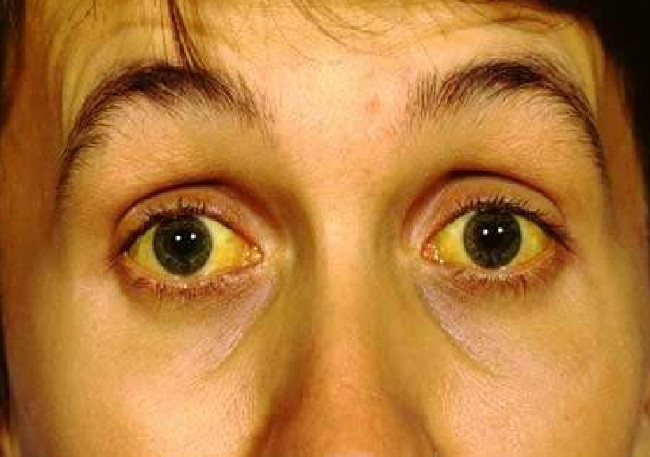 Picture 2 of Many viruses cause hepatitis, most of us do not know