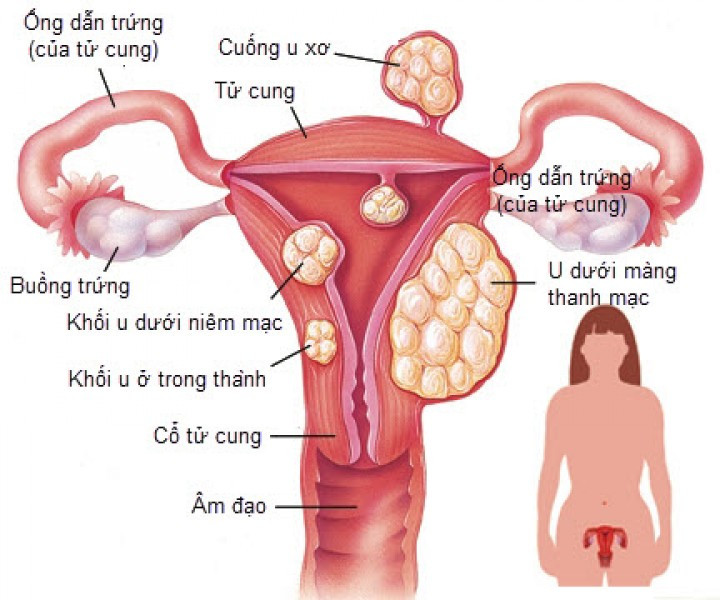 Picture 1 of Many women have fibroids without knowing it