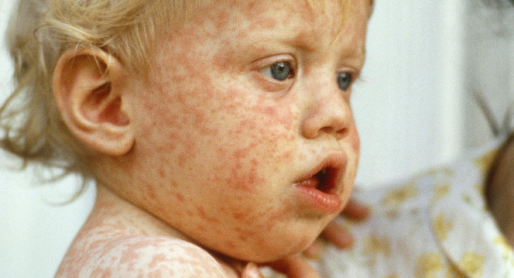 Picture 1 of Measles outbreaks spread throughout Europe
