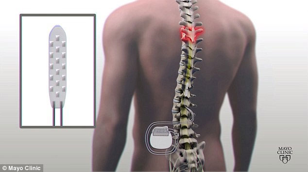 Picture 3 of Medical breakthrough: For the first time, paralysis patients can walk