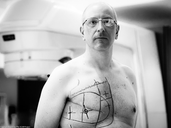 Picture 1 of Men are more likely to die if they have breast cancer