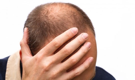 Picture 1 of Men with baldness are at risk for coronary artery disease