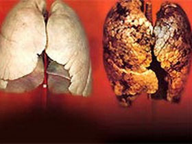 Picture 1 of Metformin can prevent lung cancer