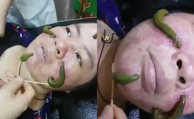 Picture 1 of Method of treating acne with leeches in China