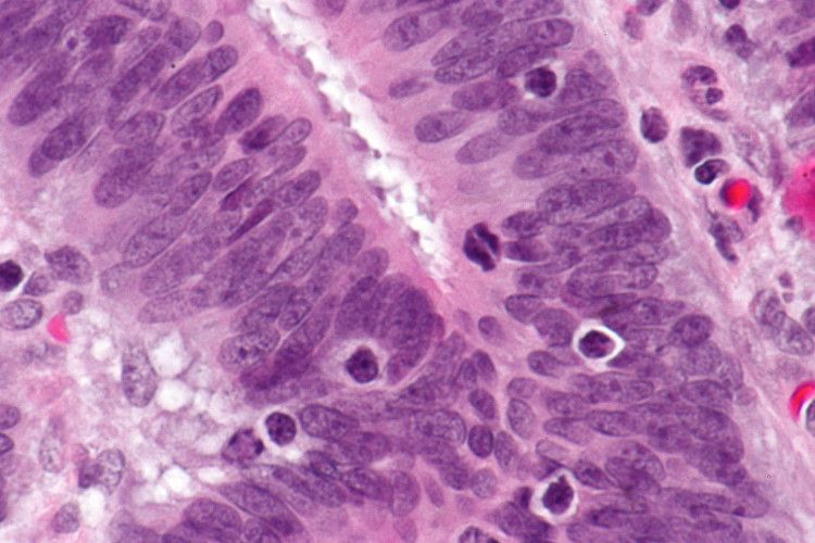 Picture 4 of Miracle diet: Starve cancer tumors like soldiers