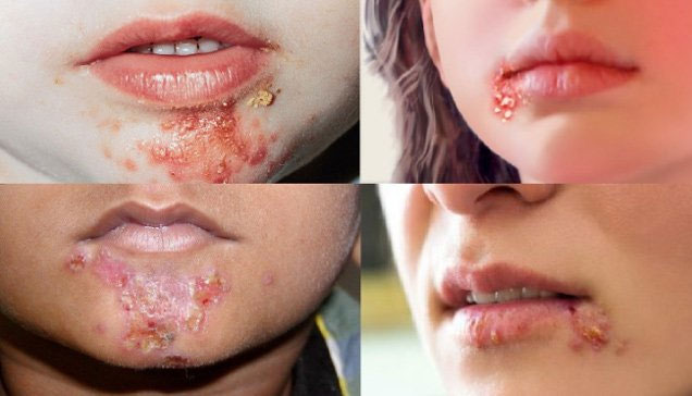 Moment: Causes, symptoms and treatment images 2