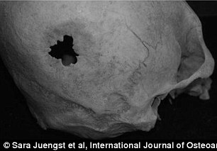 Picture 2 of More evidence of primitive brain surgery
