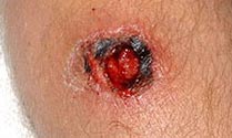 Picture 2 of MRSA is more dangerous than HIV