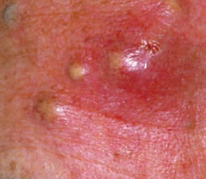 Picture 3 of MRSA is more dangerous than HIV