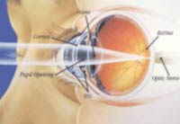 Picture 1 of Myopia - How to care for and prevent complications