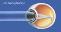Picture 2 of Myopia - How to care for and prevent complications
