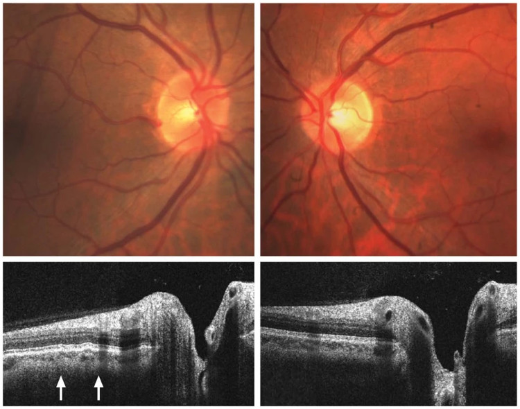 Picture 2 of Mysterious syndrome weakens astronauts' eyesight