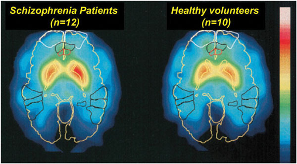 Picture 6 of Mysterious world of people with schizophrenia