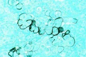 Picture 1 of Nanotechnology brings drugs to kill cancer cells