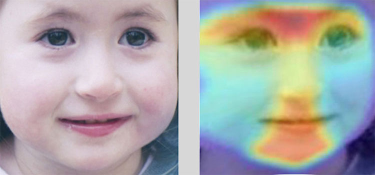 Picture 1 of Network neurons diagnosed 216 rare genetic diseases