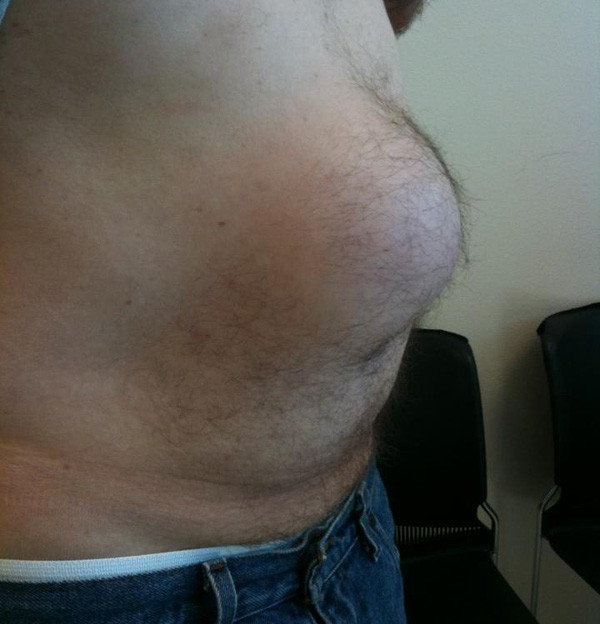 Picture 6 of Never let your belly encounter this condition