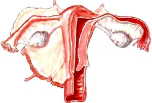 Picture 2 of New breakthrough in the treatment of ovarian cancer