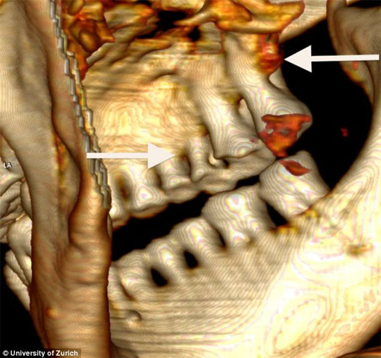 Picture 4 of New cause of the death of the Otzi gang
