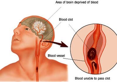 Picture 1 of New drug against stroke