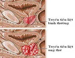 Picture 1 of New drug for treatment of prostate cancer