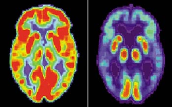 New finding: GAB2 gene linked to Alzheimer's disease images 2