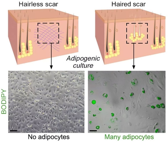 Picture 2 of New finding: 'Transplanting hair' into the wound for permanent scar removal