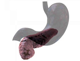Picture 1 of New hope for diabetics