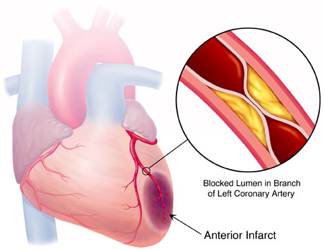 Picture 1 of New hope for patients with heart attack